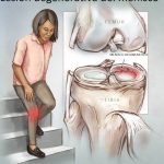 artroscopia-de-rodilla-1