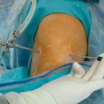 artroscopia-de-rodilla-3