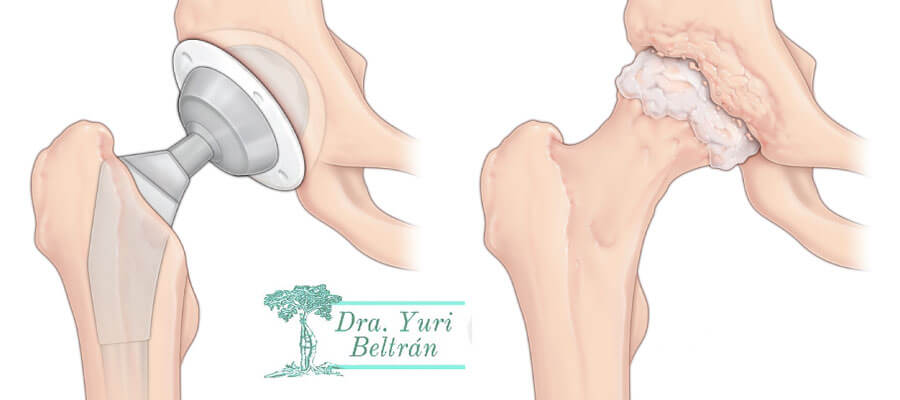protesis-de-cadera-en-lima