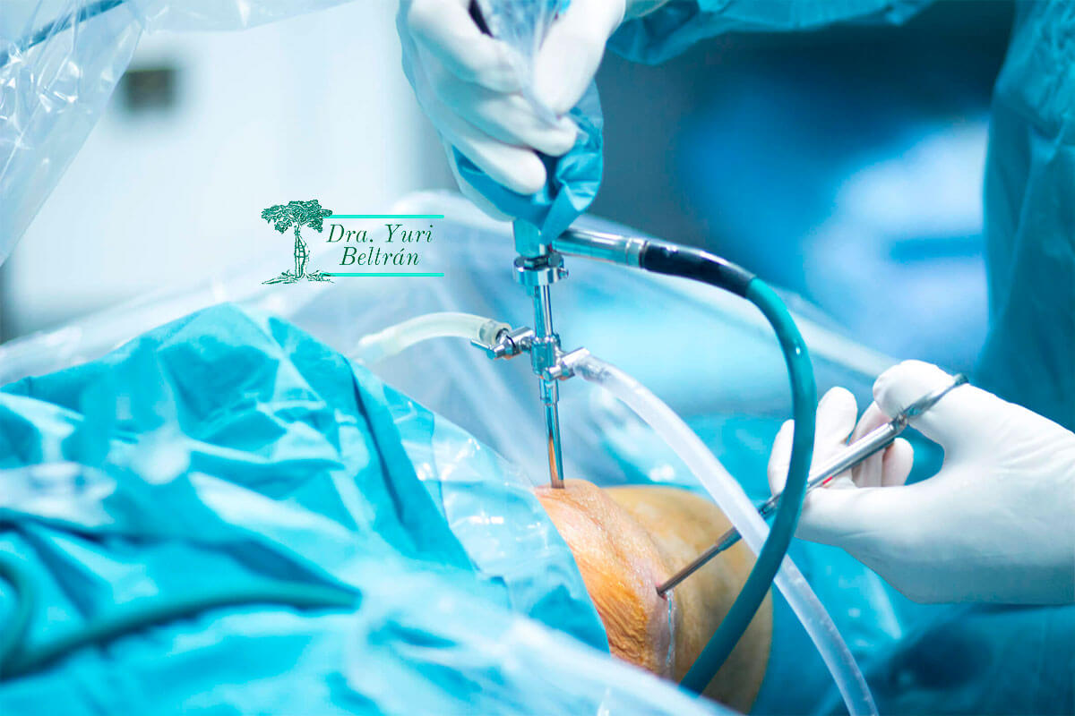 artroscopia de rodilla en Lima