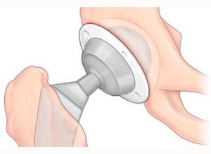 protesis-cadera